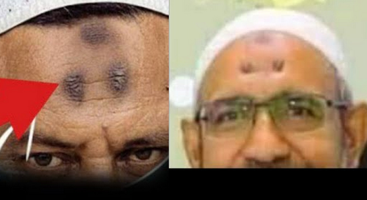 কপালে কালো দাগ হওয়া কিসের লক্ষণ