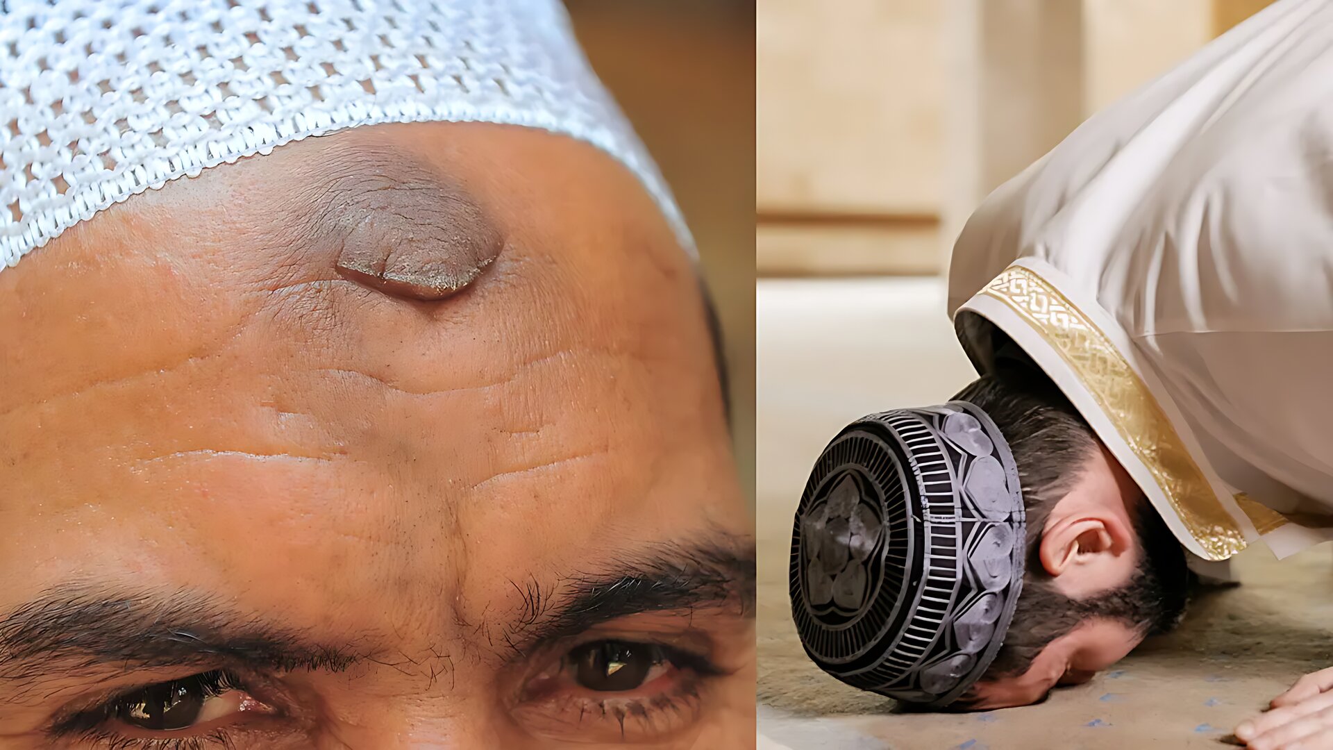 নামাজ পড়তে পড়তে কপালে দাগ ওঠা কিসের লক্ষণ