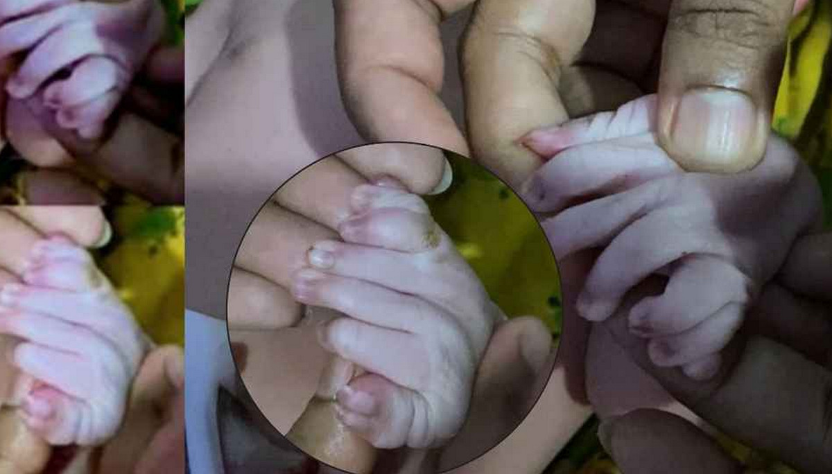 এবার ৩০ আঙুল নিয়ে এক নবজাতকের জন্ম, নেই জিহ্বাও