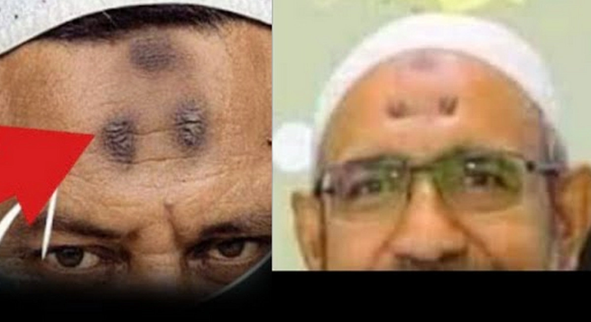 কপালে কালো দাগ হওয়া কিসের লক্ষণ
