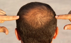 পুরুষদের চুল পড়ার পেছনে দায়ী যে ৫ বদভ্যাস